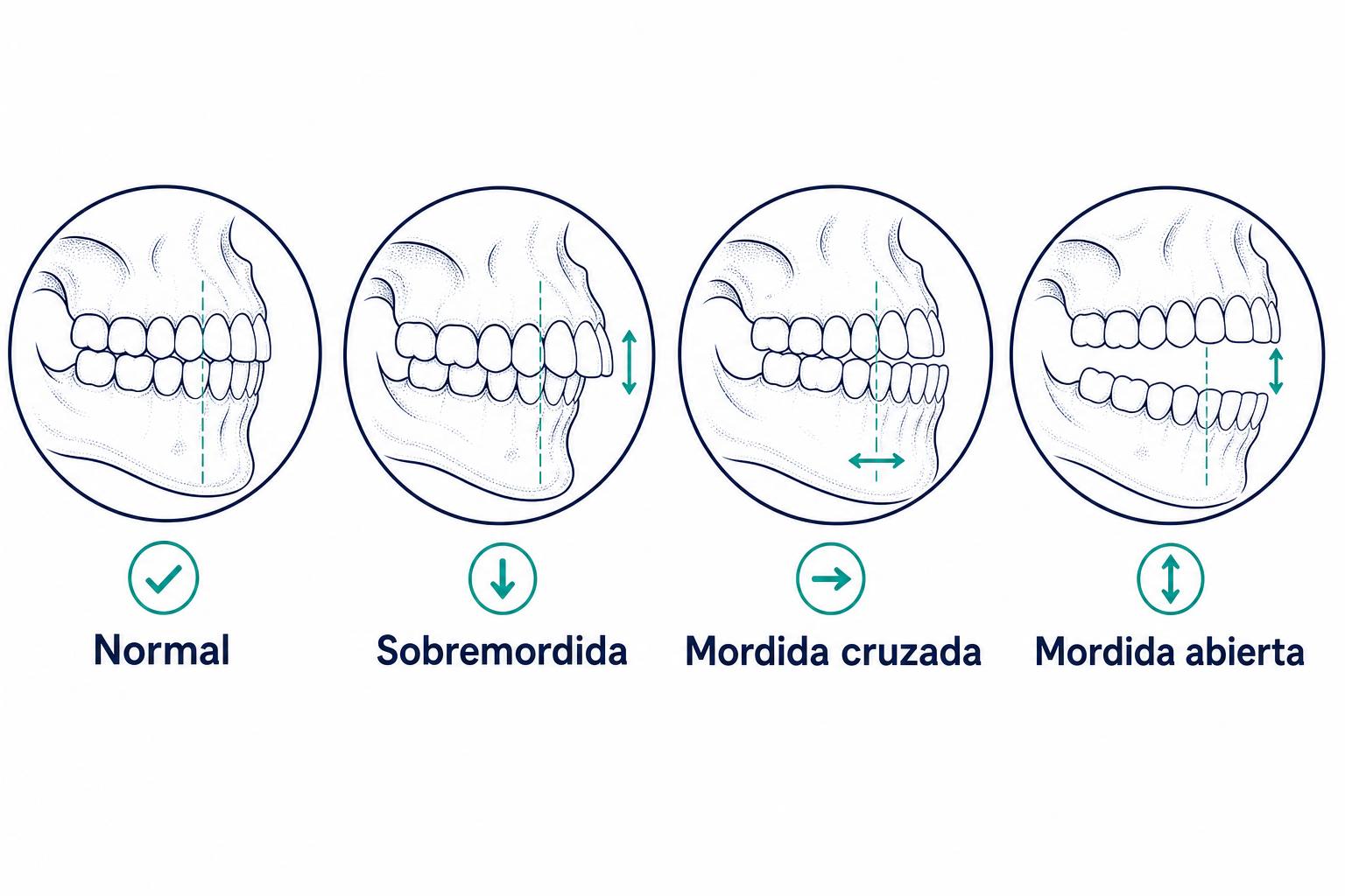 Tipos de mordida